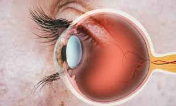 Effective Damaged Retina Treatment at ISHA NETR... main image