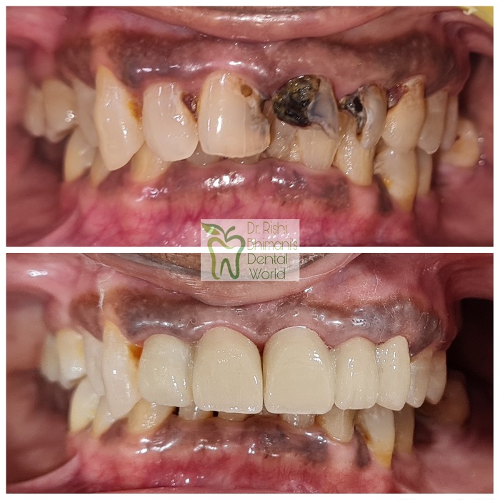 Tooth Decay has a negative impact on the smile ... main image