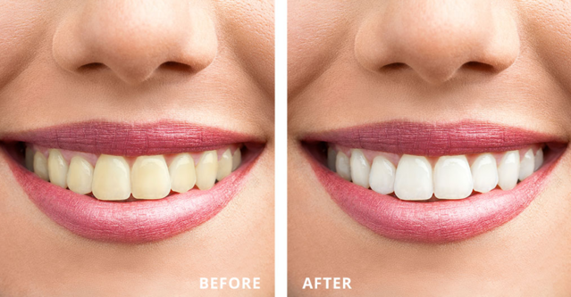 Brighten Your Smile with Teeth Whitening Process a... main image