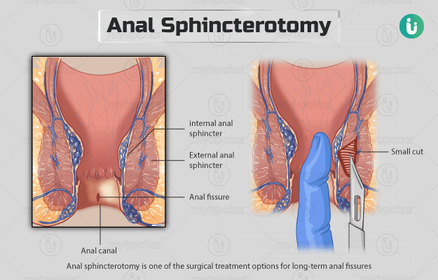 Sphincterotomy simply means dividing the sphinc... main image