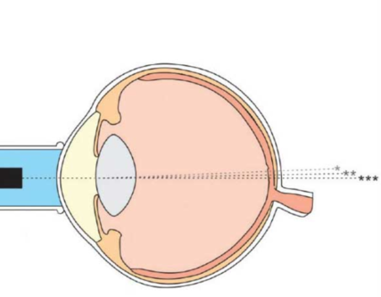 Precise Eye Measurements with Scanmate Immersion A... main image