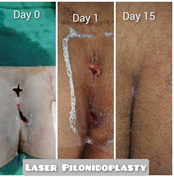Pilonidal Sinus is surgical problem.It is seen ... main image