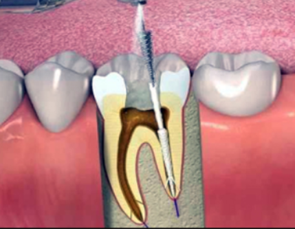Painless RCT Treatment in Thane - Everything You N... main image