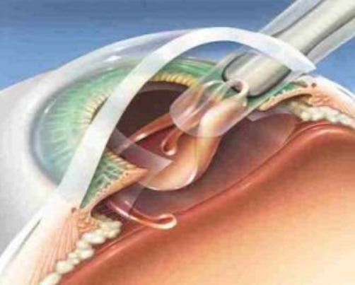 Vision Correction with Micro-incision Phacoemul... main image