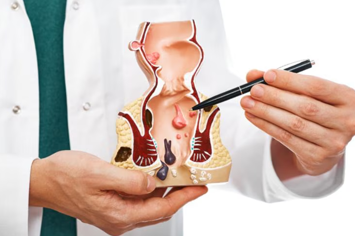 Comprehensive Piles Treatment by a Piles Doctor... main image