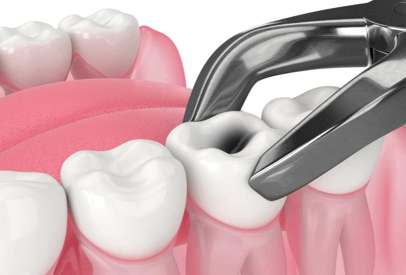 Your Guide to Tooth Extraction Procedure at Dr. Ra... main image