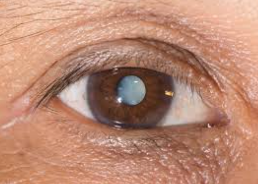 Swelling in Retina Treatment Near Me at ISHA NE... main image