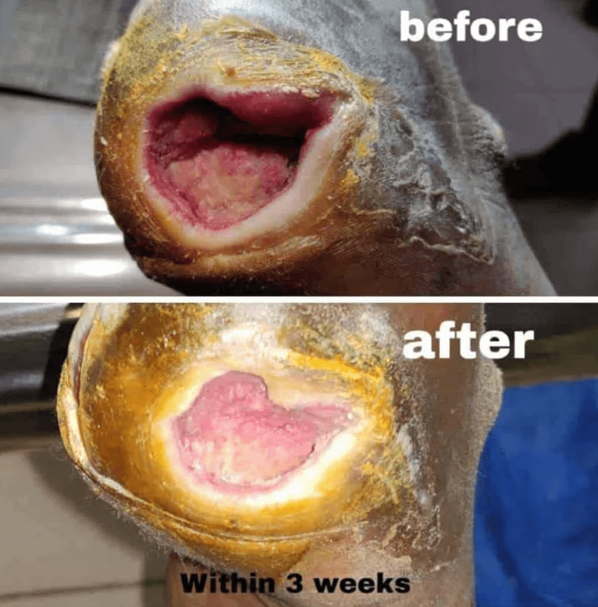 PRP Therapy for Non-Healing Wounds: Specialized... main image