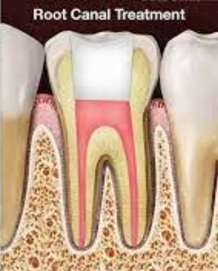Root Canal Treatment in Jaipur Best Root Canal ... main image