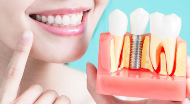 Dental Implant Surgery at Dr. Rai's Dental Avenue,... main image