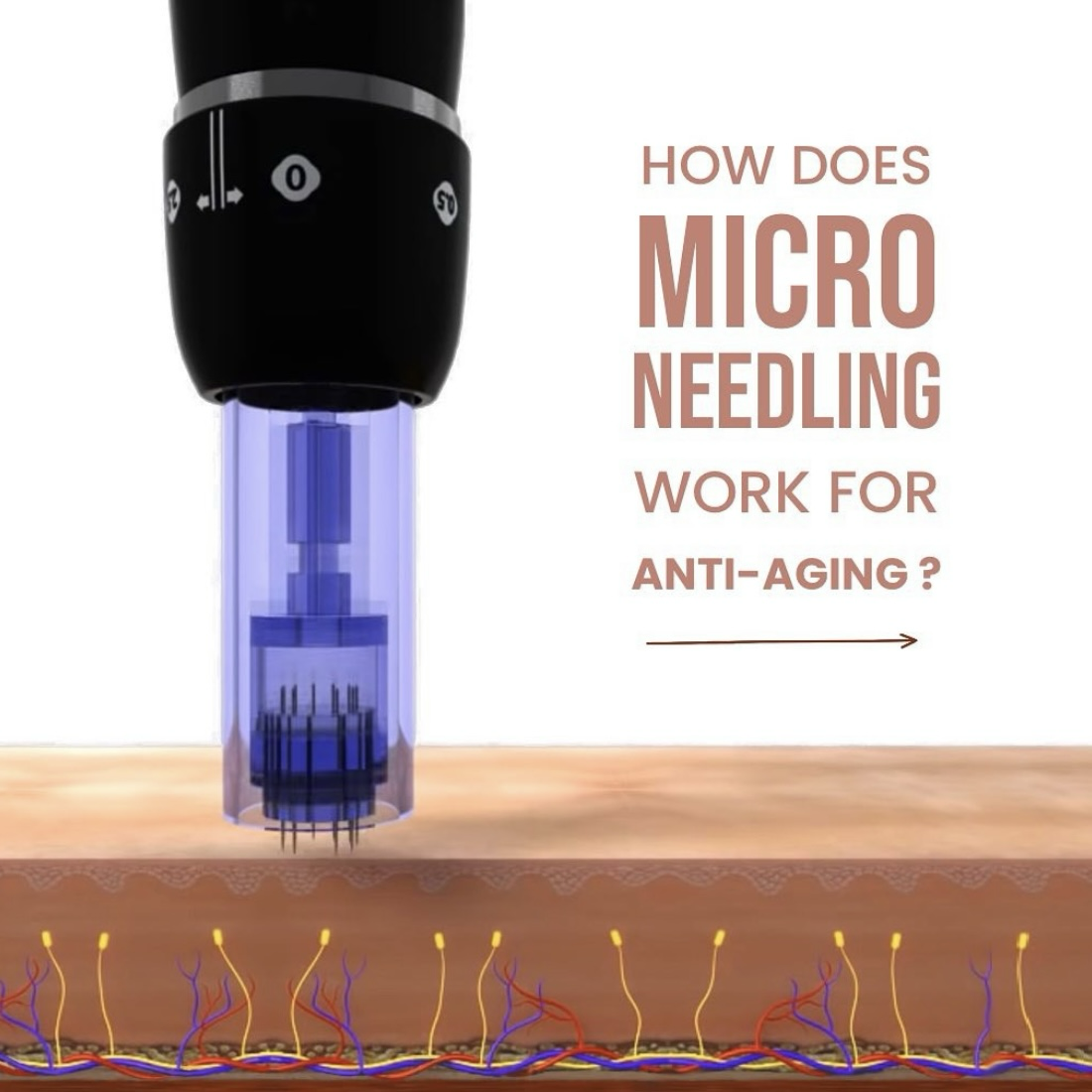 How Microneedling Helps with Anti-Ageing: A Compre... main image