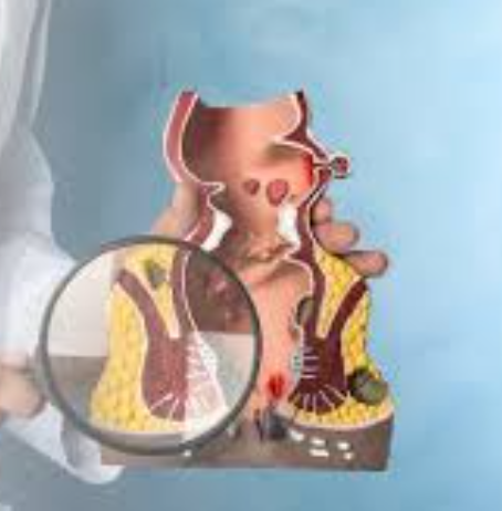Expert Piles Specialist in Pune: Dr. Phapale Ho... main image