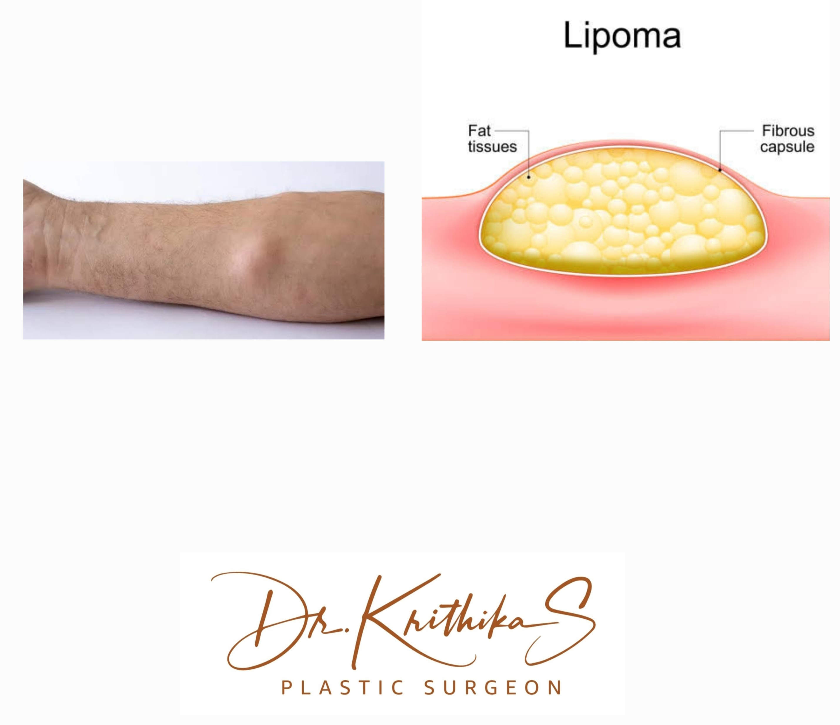 

A lipoma is a round or oval-shaped lump of ti... main image