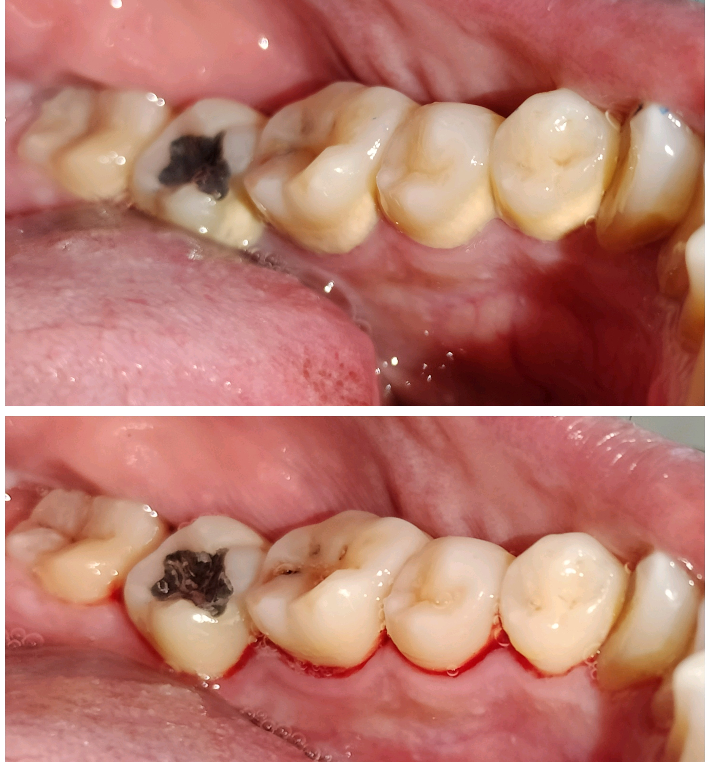 full mouth ultrasonic scaling for removing the ... main image