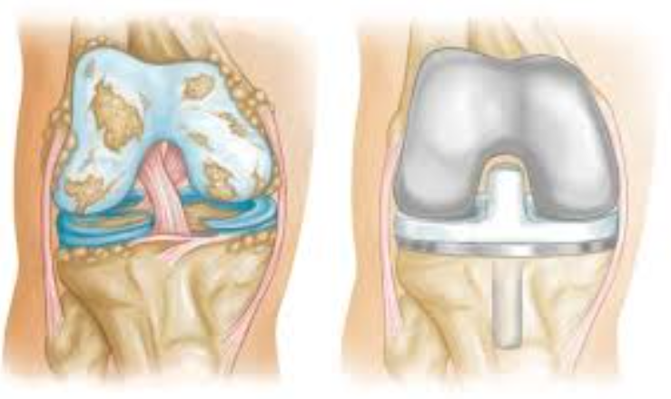 Maa Card: Your Key to Affordable Knee Joint Rep... main image