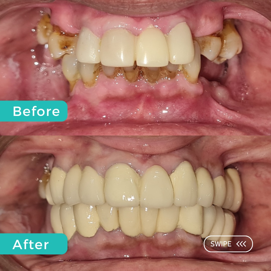 Missing teeth has a negative impact on digestio... main image