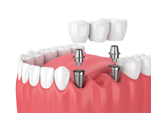 Implants Services in Nagpur at Mogre Dental Cli... main image