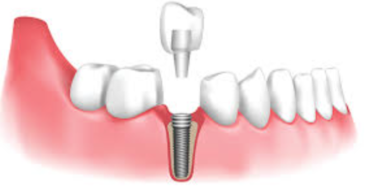 Dental Implant in Jaipur Top Dental Implant Ser... main image