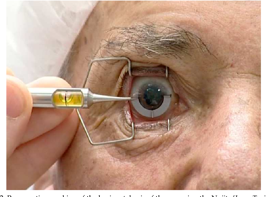 Multifocal and Toric IOL Surgery at Green City ... main image