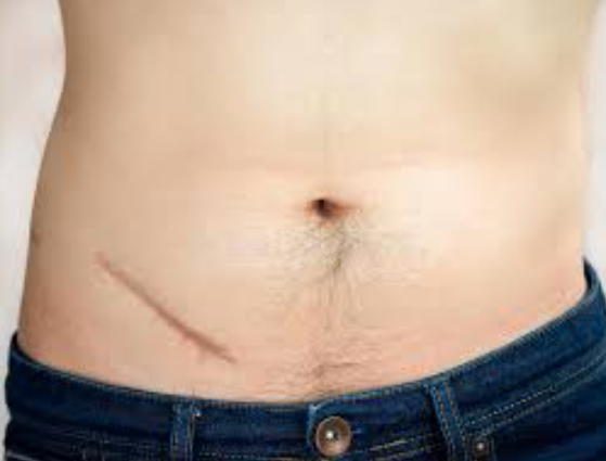 Expert Appendix Surgery Near Me Best Appendix S... main image