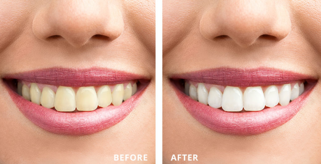 Achieve a Brighter Smile with Teeth Whitening at D... main image