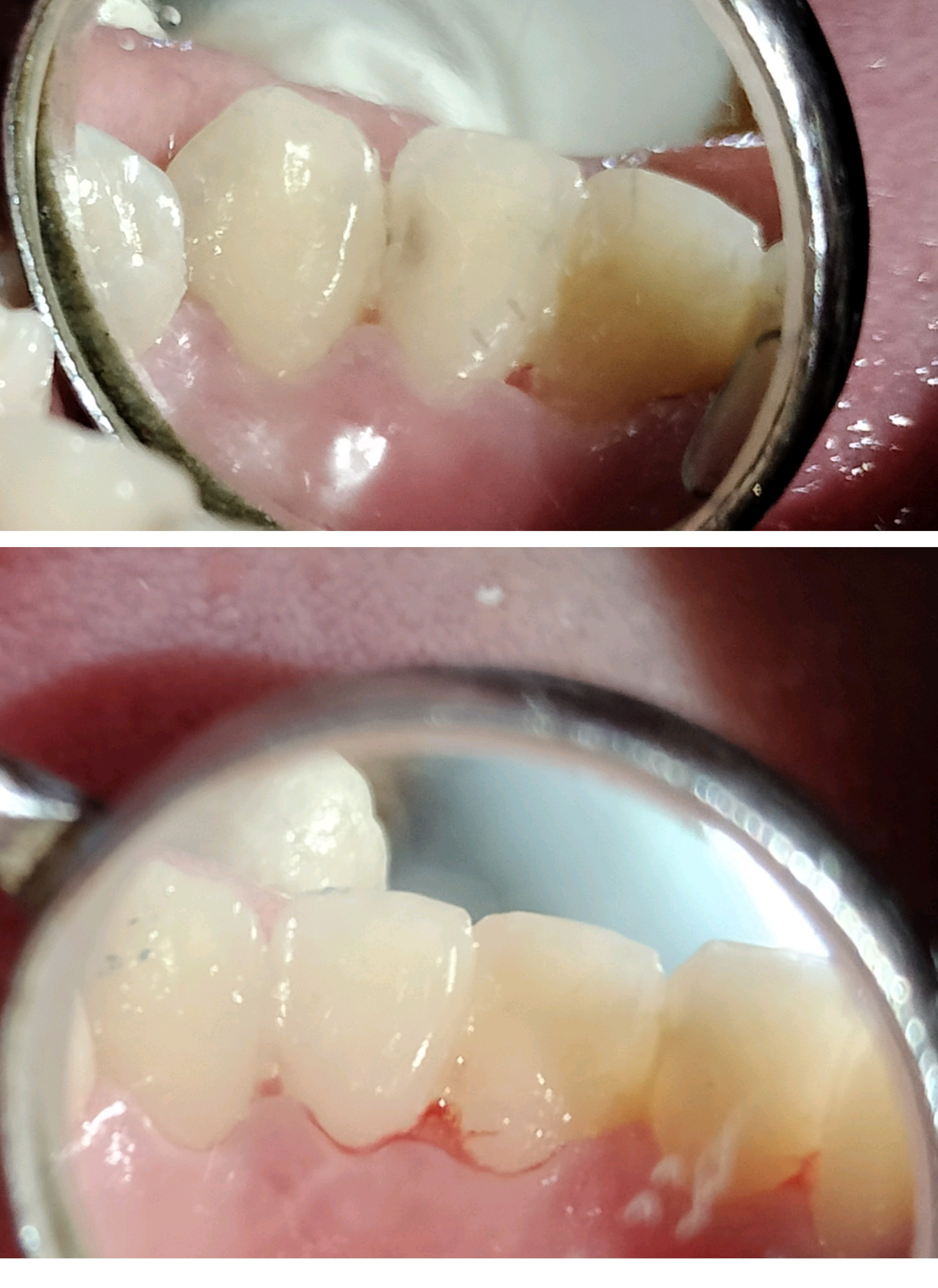 Tooth colored cosmetic filling or restoration o... main image