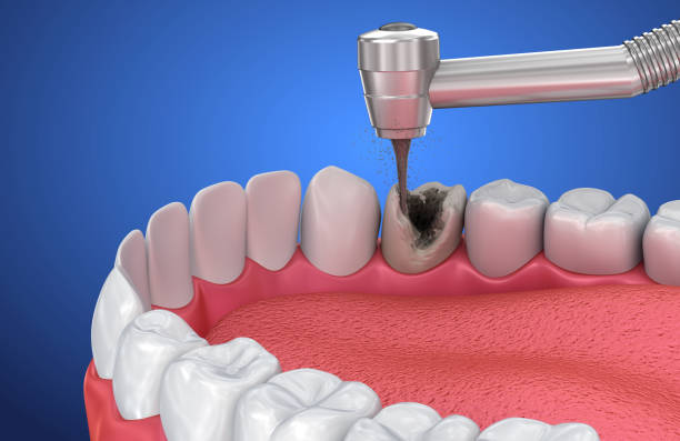 #Best root canal treatment near me main image