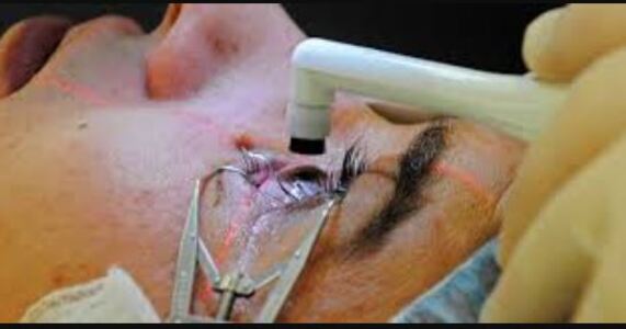No Injection, No Bandage Cataract Surgery at Green... main image