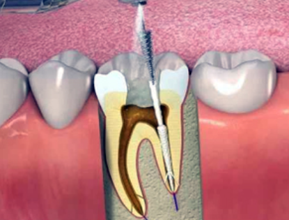Root Canal Treatment at Dr. Rai's Dental Avenue Be... main image