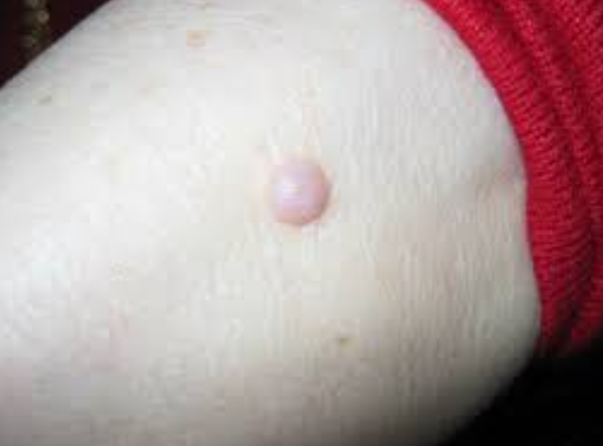 Neurofibroma Management: Expert Care at SA Hosp... main image