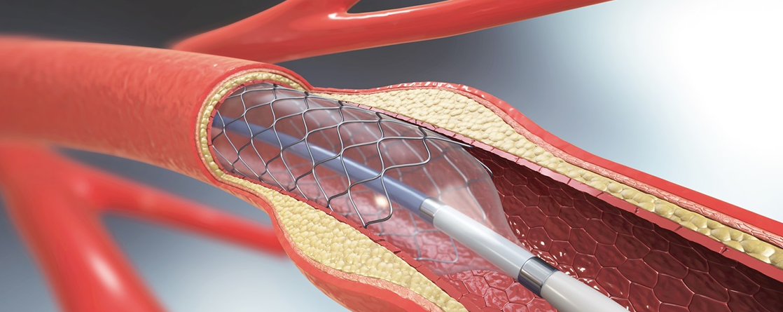 Best Angioplasty Near Me at Medinova Super Special... main image