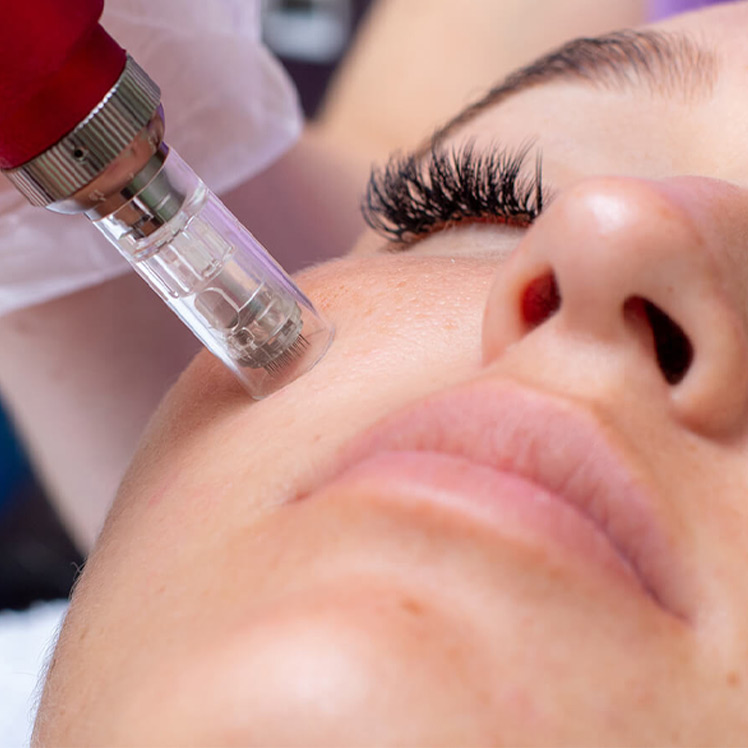 Vampire Facial / Vampire Facelift / Non Surgica... main image