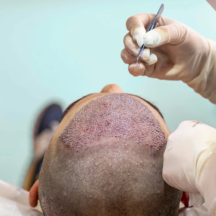 As Best Hair Transplant Clinic in Thane we prov... main image