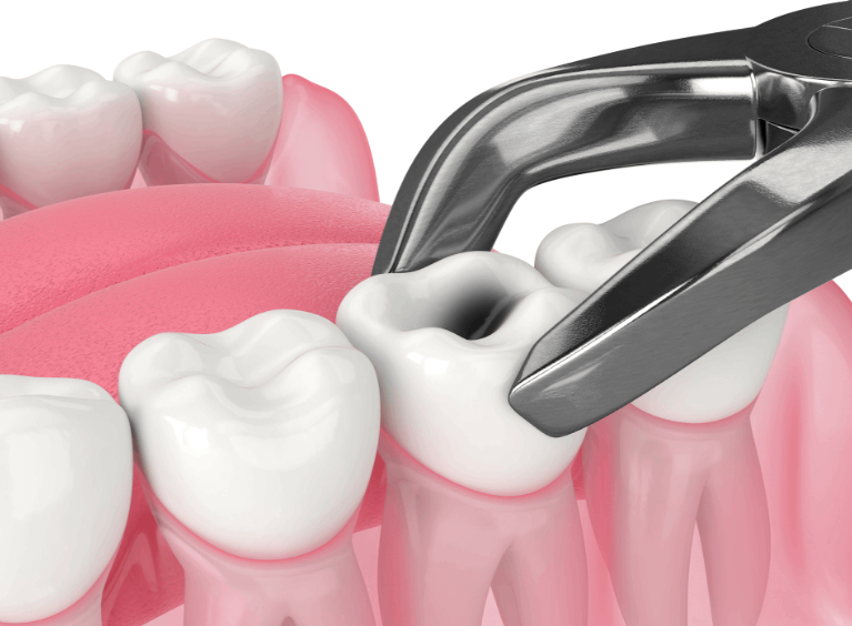Tooth Extraction Procedure at Dr. Rai's Dental Ave... main image