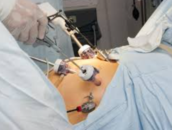 Key Hole Surgery Explained: A Minimally Invasiv... main image