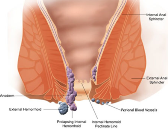 Expert Piles Surgeon Near Me Expert Piles Surge... main image