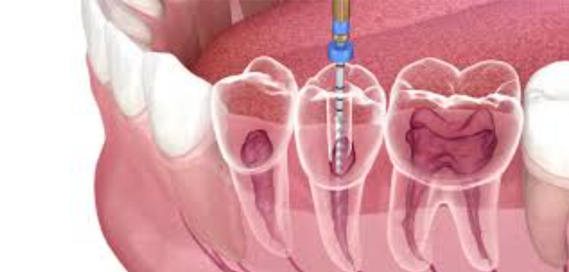 Best Root Canal Specialist in Nagpur at MOGRE C... main image