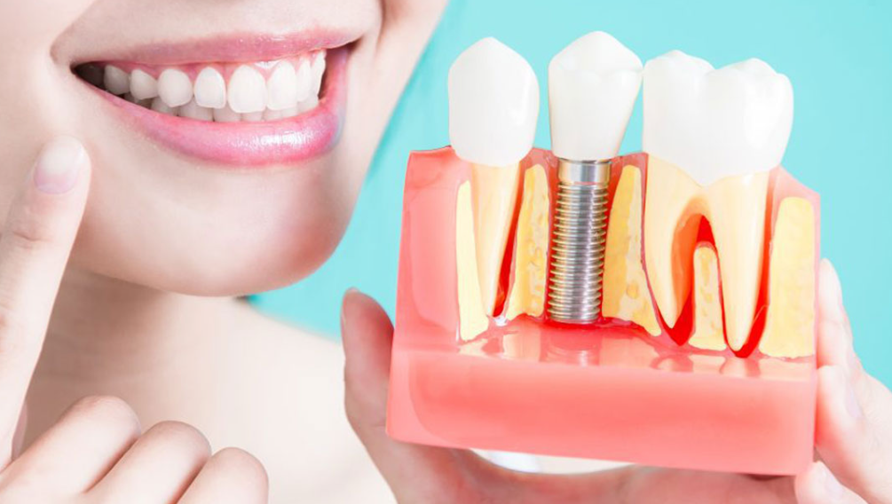 Dental Implant Surgery at Dr. Rai's Dental Avenue ... main image