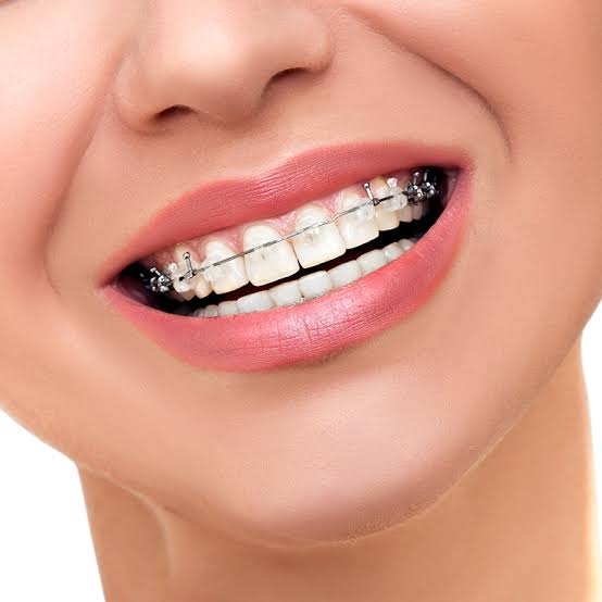 Focusing on self-ligating braces for Paras Dent... main image