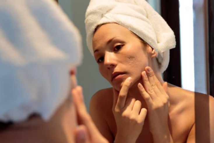 Advanced Acne and Acne Scars Treatment near MRC Na... main image