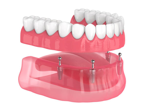 Best Smile Designing and Implant Services in Nagpu... main image