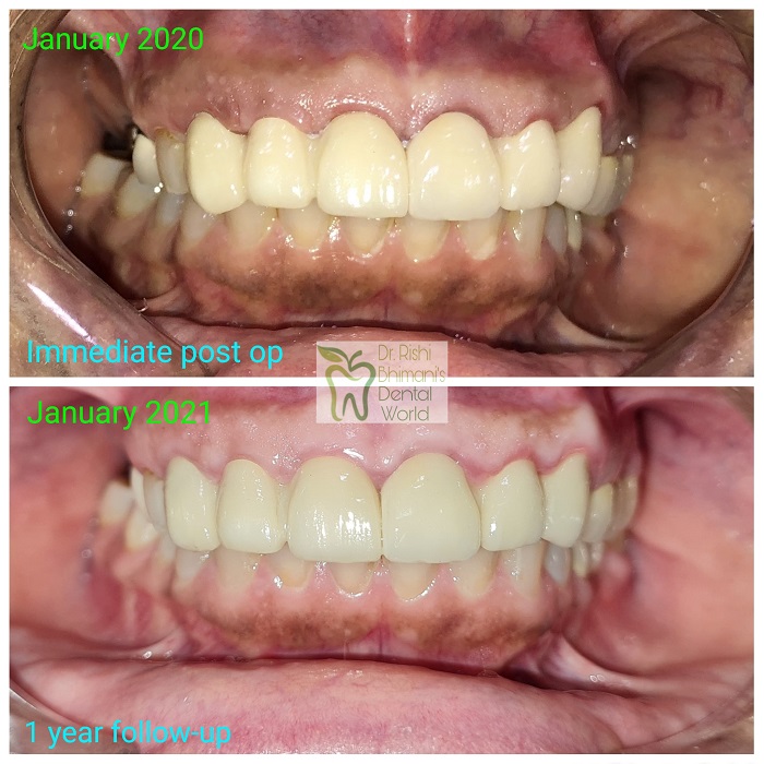Smile Makeover or rehabilitation comprises of a... main image