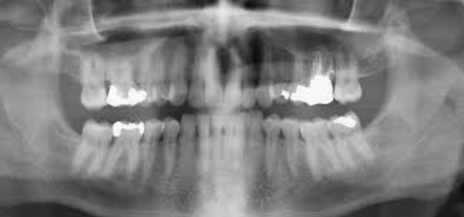 OPG (Dental Imaging)