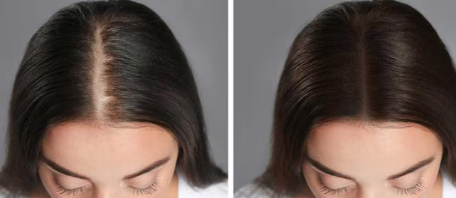 Say Goodbye to Hair Fall with ELORAA CLINIQ Eff... main image