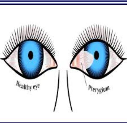 Pterygium Removal at Green City Eye Clinic, Nag... main image