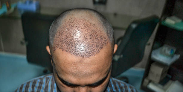 Best Hair Transplant in Chennai Transform Your Loo... main image