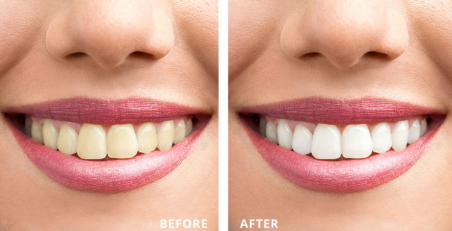Teeth Whitening Process at Dr. Rai's Dental Avenue... main image