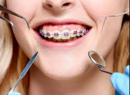 Braces Treatments at Dr. Rai's Dental Avenue Exper... main image