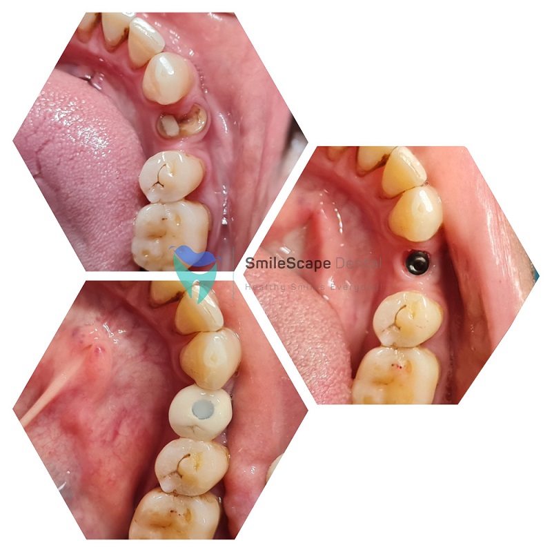Broken or fractured teeth pose problems in eati... main image