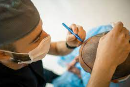 Find the Best Hair Transplant Near Me at ELORAA... main image